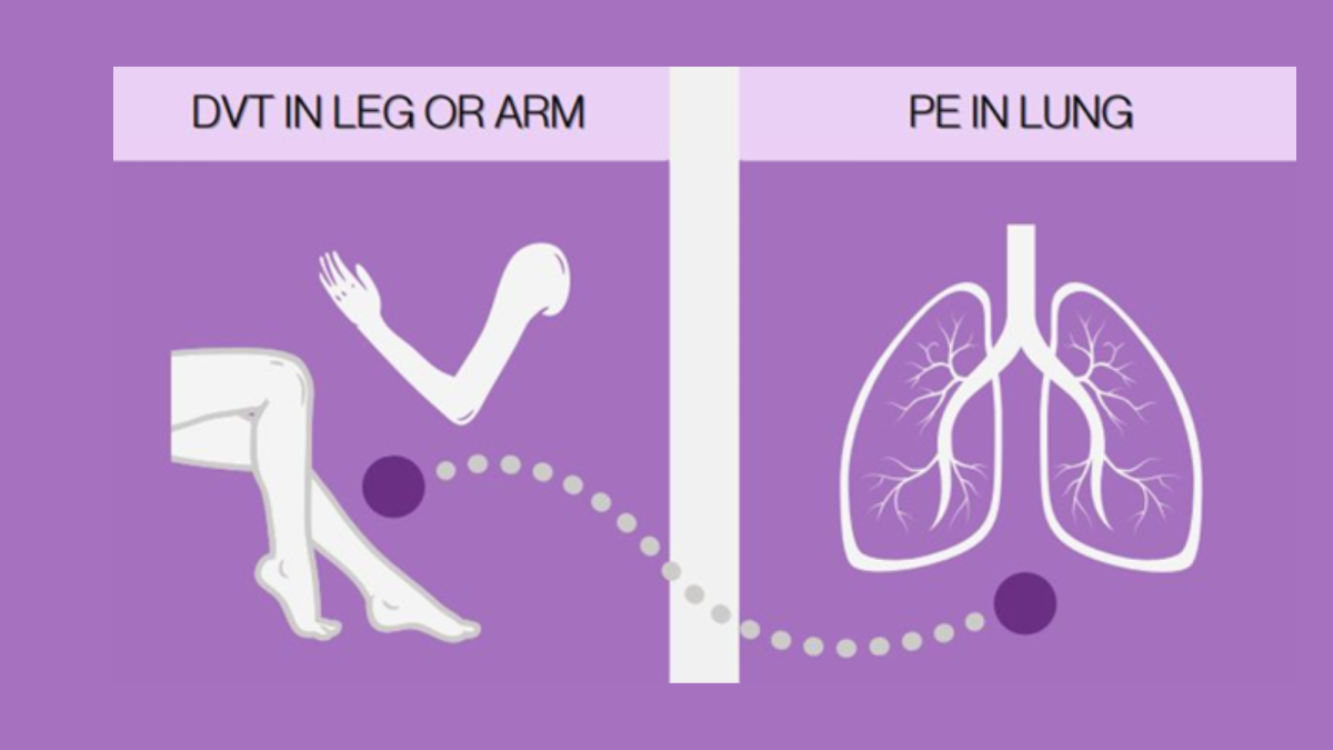 illustration of blood clot moving from leg/arm to lungs